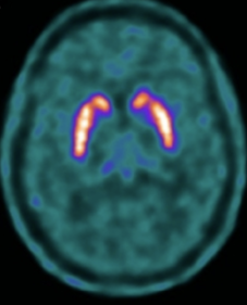 Fixation des striatas lors d'un TEPscan à la DOPA chez un sujet sain