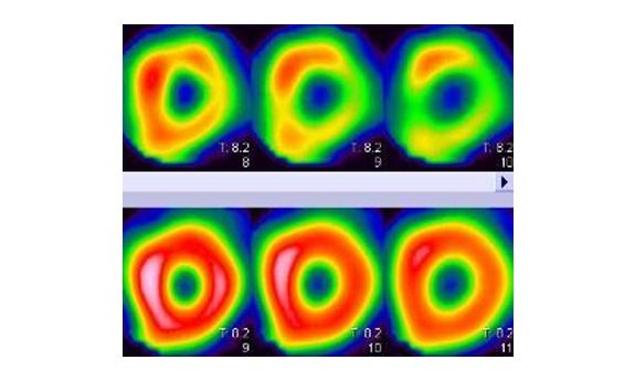 Scintigraphie myocardique