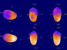 Scintigraphie de perfusion myocardique - Rendu de surface 3D