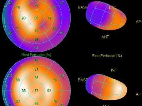 Scintigraphie de perfusion myocardique - Segmentation internationale