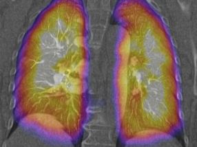 Scintigraphie pulmonaire